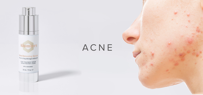 Acne-treatment