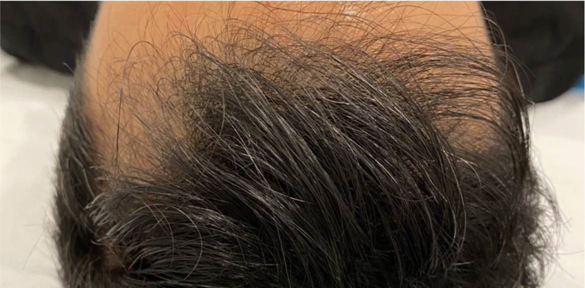 PRP Hair Restoration before and after