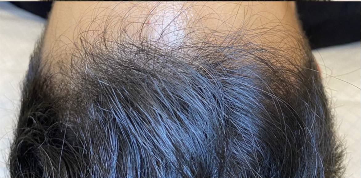 PRP Hair Restoration before and after