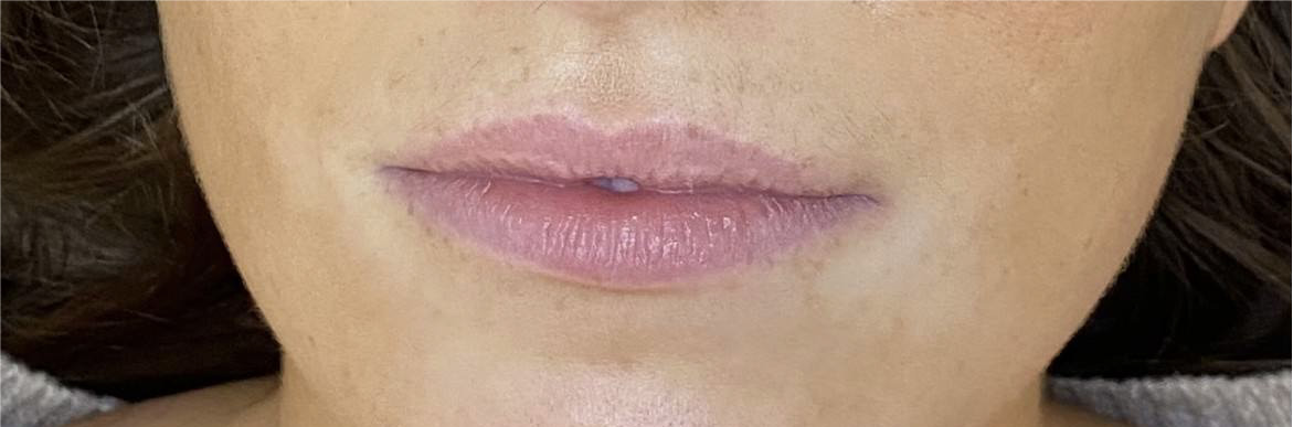 COSMETIC BEFORE AND AFTERS lip filler