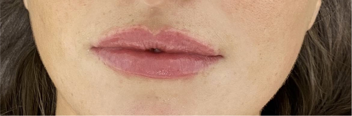 COSMETIC BEFORE AND AFTERS - lip filler