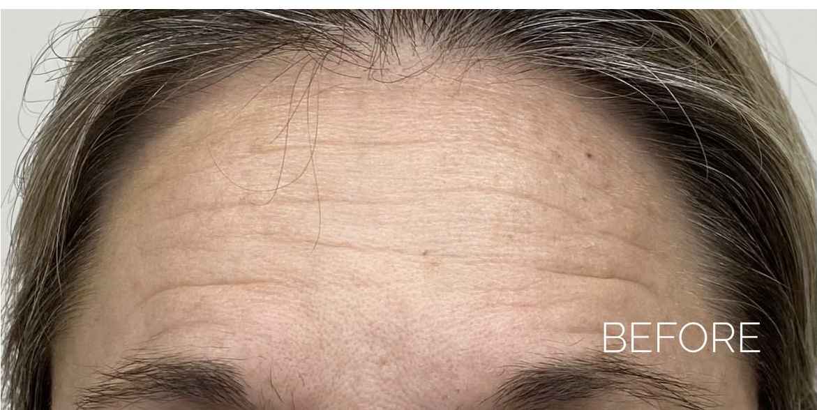 Botox forehead before and after